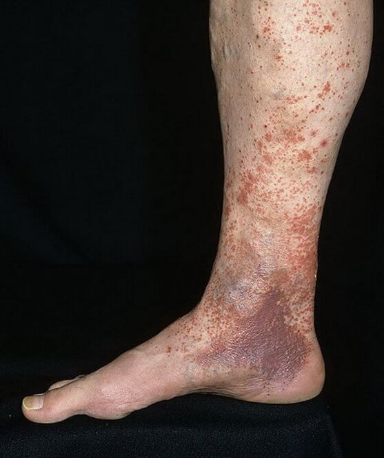 Krásná dermatitida