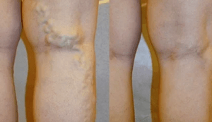 příznaky a příznaky křečových žil na nohou u mužů
