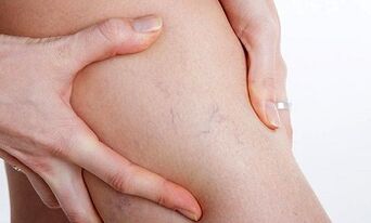 důvody pro rozvoj křečových žil na nohou