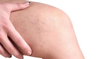 fáze vývoje křečových žil