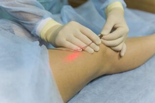 laserové ošetření křečových žil podstatou postupu
