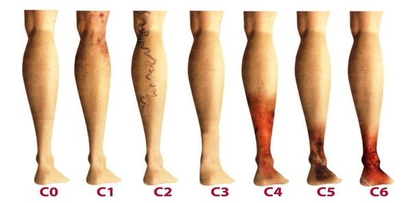 stadia vývoje křečových žil na nohou