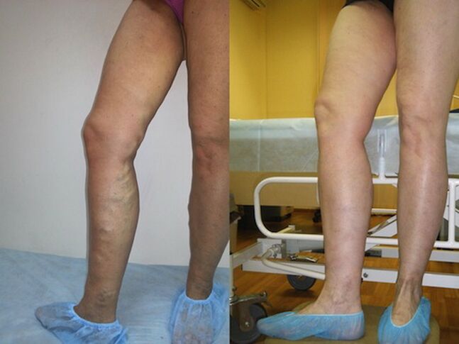 Nohy před a po laserové léčbě křečových žil