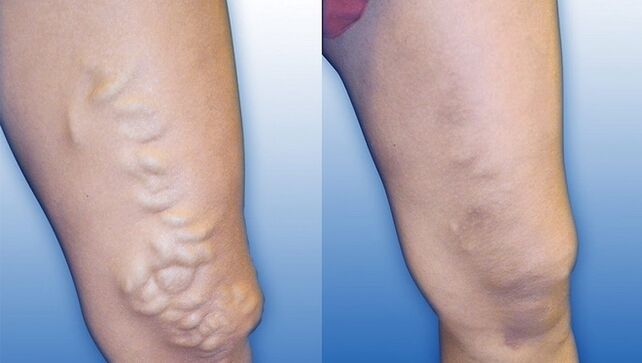 Nohy před a po léčbě závažných křečových žil