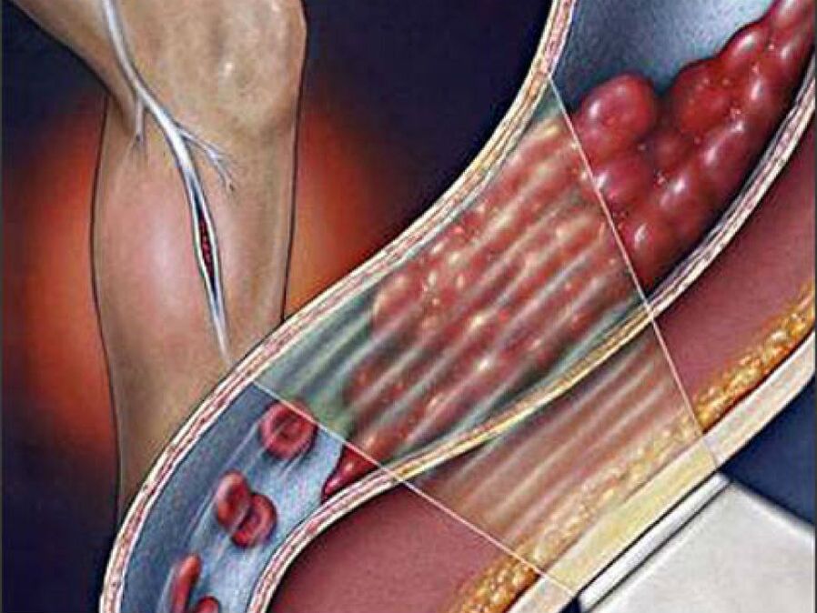 hluboká žilní trombóza jako komplikace křečových žil