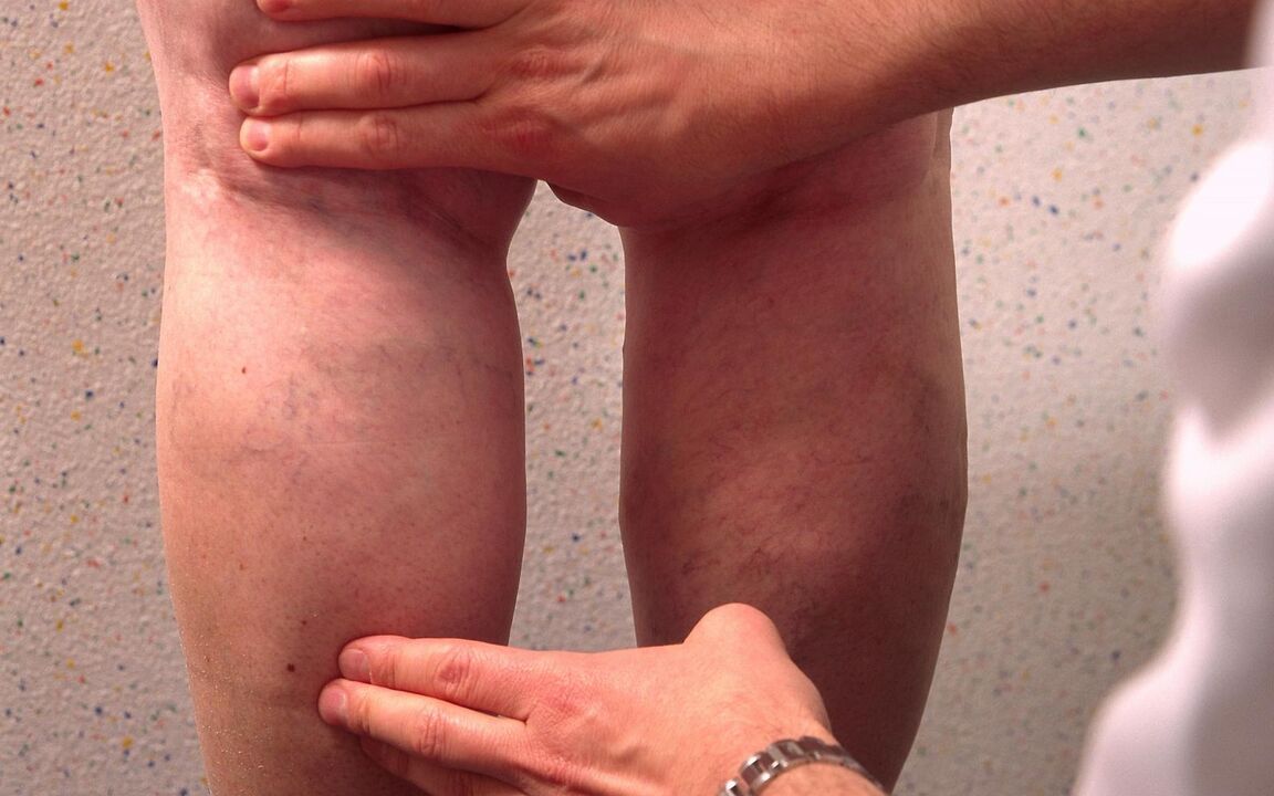 lékař vyšetří nohy s křečovými žilami