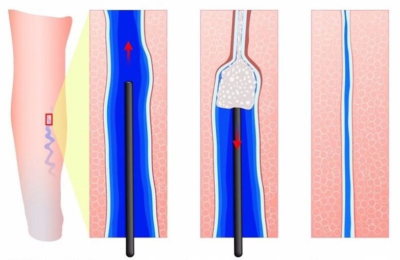 skleroterapie pro křečové žíly na nohou u mužů